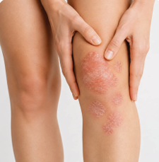 Thick chronic plaques particularly on the trunk extremities elbows and knees