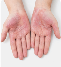 Localized hyperkeratotic palmoplantar lesions