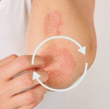 Recurrent flares requiring intermittent topical treatment